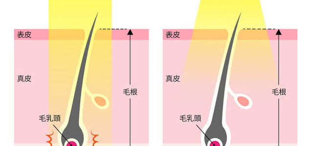 エステ脱毛
