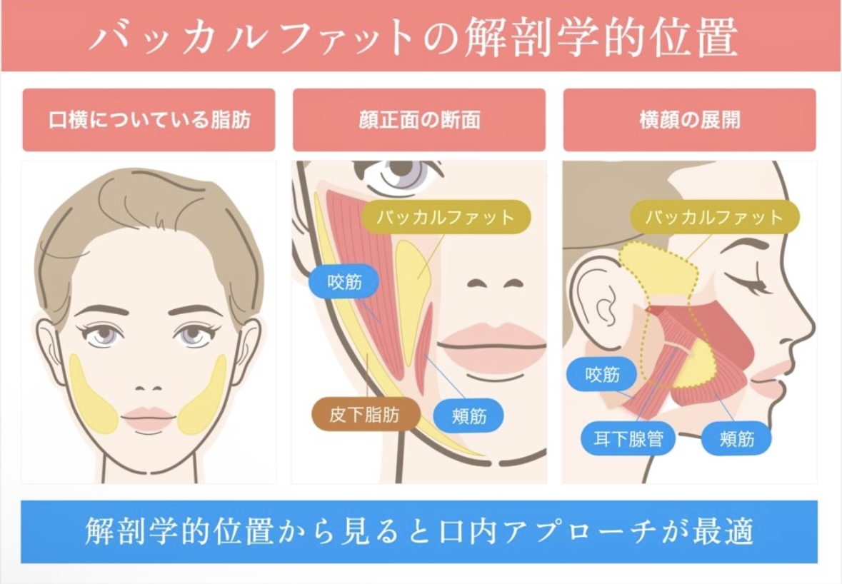 バッカルファット